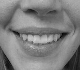 Smiley Piercing/ Lippenbändchen