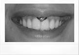 Smiley Piercing/ Lippenbändchen.