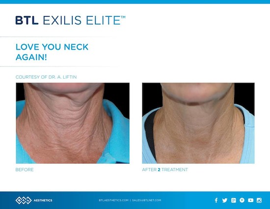 News: BTL Exilis Elite™ - Modernste Technik zur Hautstraffung!