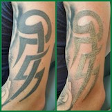 News: Tattoos - wenn sie nicht für immer bleiben sollen. (28.06.2018)