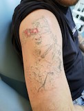News: Tattoo-Entfernung (02.07.2018)