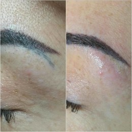 Korrektur von Permanent-Makeup