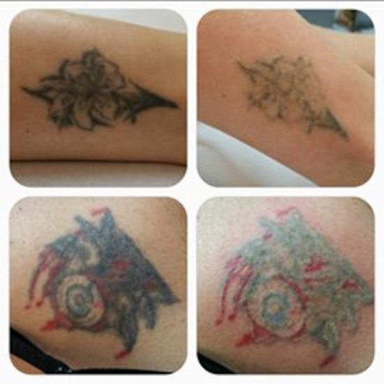 Vorbereitung für ein Cover up • News SkinWorks