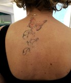 News: Cover up nach einer Vorbehandlung durch Laser. (05.03.2020)